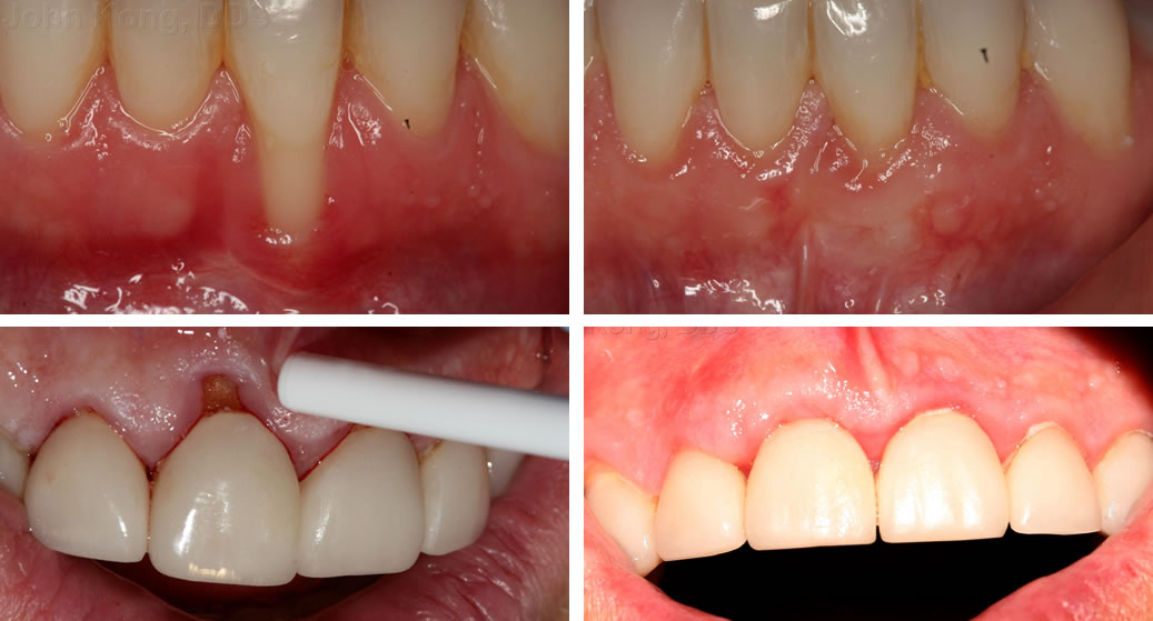 Connective tissue gum graft to cover recession