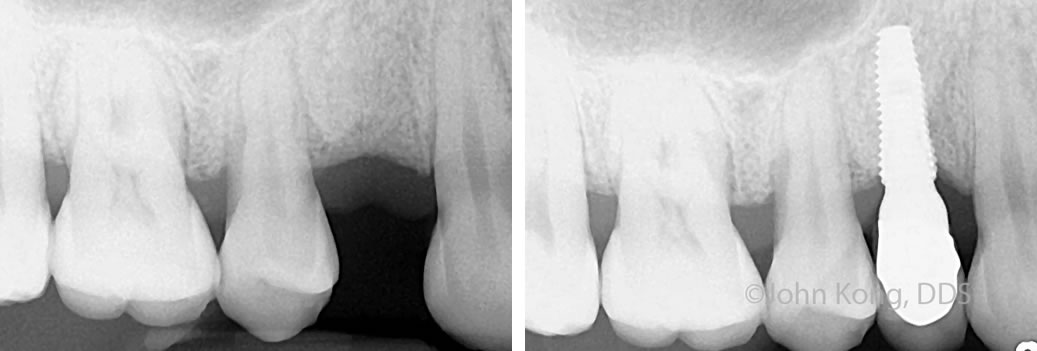 xray of restored dentium dental implant