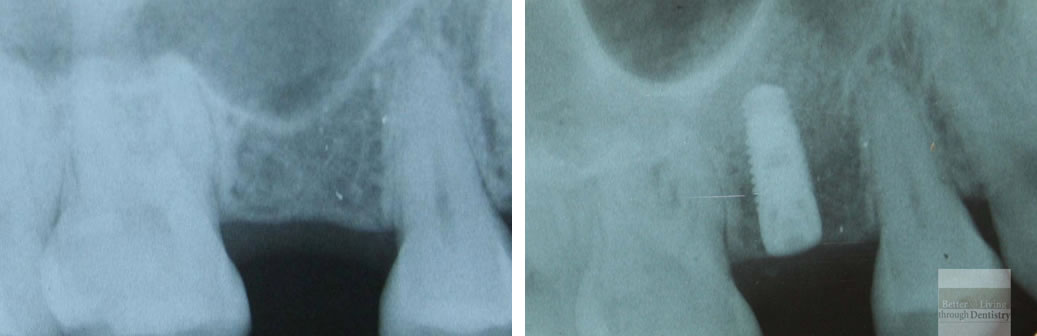 sinus lift bone grafting with dental implant