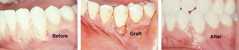 Gum Grafting by Better Living Dentistry in Queens, NY