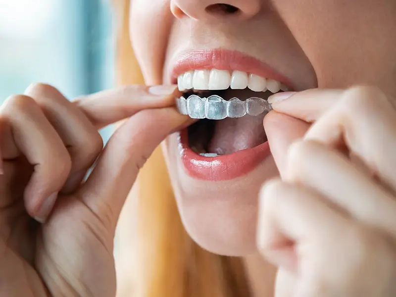 Female fitting a clear aligner or invisalign