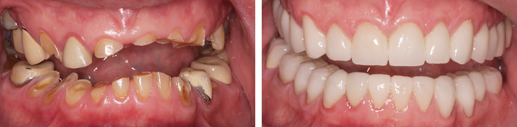 Before and After Case
