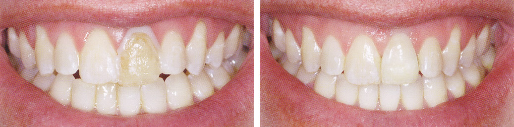 Before and After Case