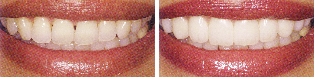 Before and After Case
