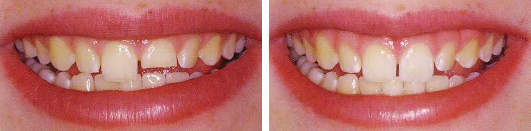 Before and After Case