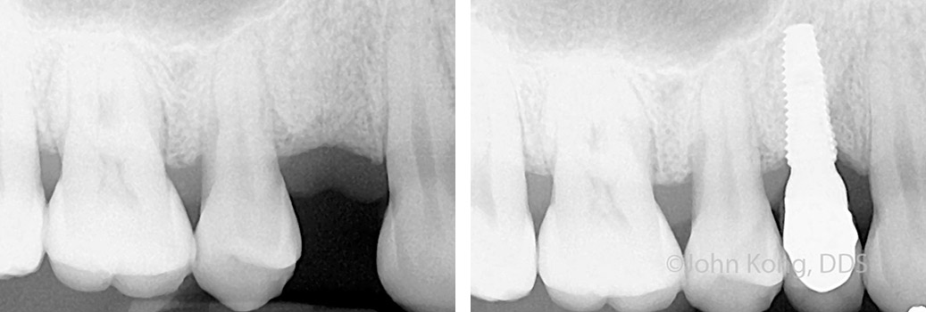 Before and After Case