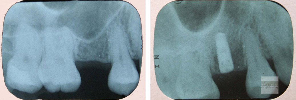 Before and After Case