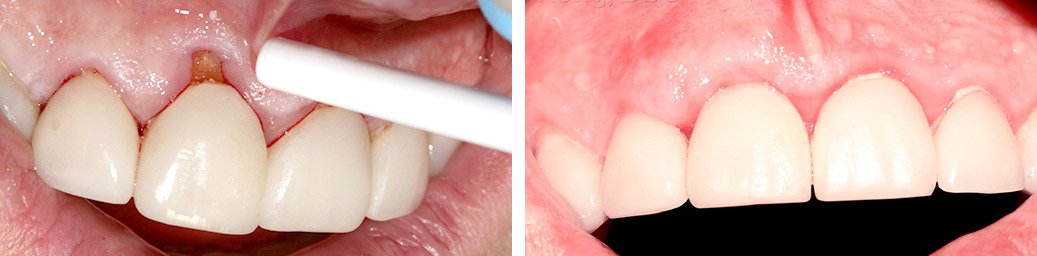 Before and After Case